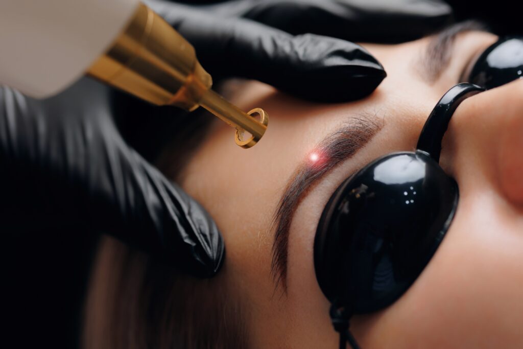 Technician performing laser tattoo removal on eyebrow area of a female client